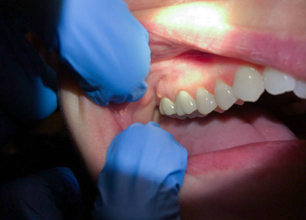 Best Emergency Treatment for Dental Infections or Abscesses in Harrison, WI